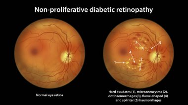 Non-proliferative diabetic retinopathy, illustration showing normal eye retina and retina with hard exudates, microaneurysms, dot haemorrhages, flame-shaped and splinter retinal haemorrhages clipart