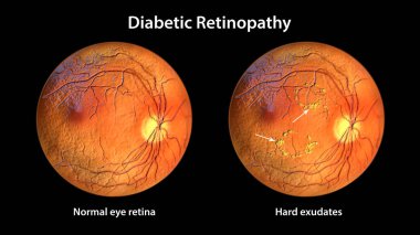 Yaygın olmayan diyabetik retinopati, normal göz retinasını ve retinasını gösteren üç boyutlu illüstrasyon (düzensiz şekilli sarı noktalar))