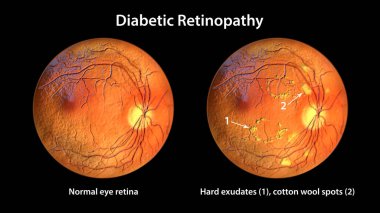 Non-proliferative diabetic retinopathy, 3D illustration showing normal eye retina and retina with hard exudates, and cotton wool spots clipart