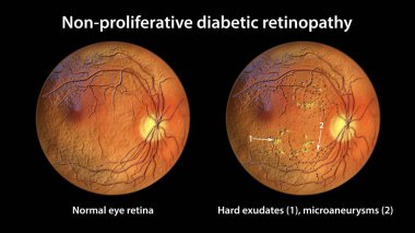 Yaygın olmayan diyabetik retinopati, göz retinasını ve retinasını gösteren 3 boyutlu illüstrasyon.