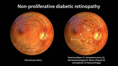 Üretici olmayan diyabetik retinopati, göz retinası ve retinayı gösteren 3 boyutlu illüstrasyon, sert çıkışlı normal göz retina ve retina, mikroanevrizmalar, nokta kanamalar, alev şeklinde ve retinal kanamalar.