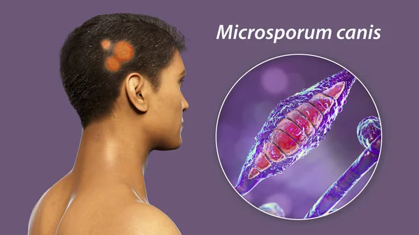 Fungal infection on a man's head and close-up view of Microsporum canis fungi, 3D illustration. Ringworm, Tinea capitis