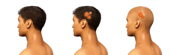 Fungal Infection Man Head Illustration Tinea Capitis Caused Fungi Microsporum — Stock Fotó