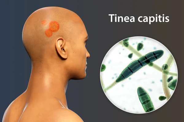 Fungal infection on a man\'s head, 3D illustration of a man with Tinea capitis and close-up view of fungi Trichophyton rubrum