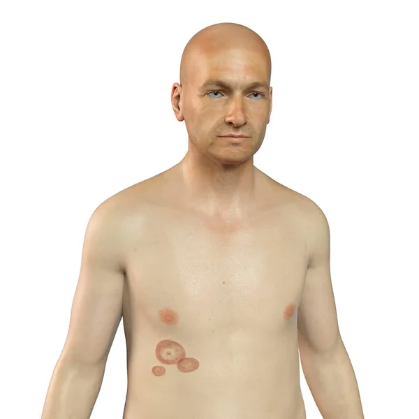 Fungal Infection Man Body Tinea Corporis Illustration — Stockfoto