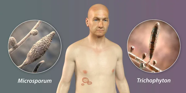 Plísňová Infekce Těle Muže Tinea Corporis Detailní Pohled Dermatofytové Houby — Stock fotografie