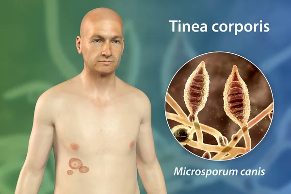 Fungal infection on a man\'s body. Tinea corporis and close-up view of dermatophyte fungi Microsporum canis, 3D illustration