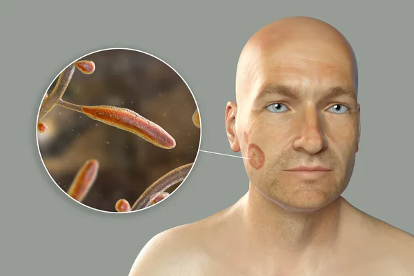Houbová Infekce Mužské Tváři Ilustrace Muže Tinea Faciei Detailní Pohled — Stock fotografie