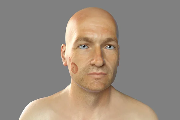 Fungal infection on a man\'s face, 3D illustration. Tinea faciei, caused by fungi Microsporum canis, Trichophyton rubrum, T. mentagrophytes and other