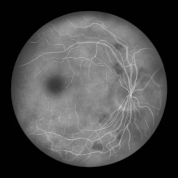 Nonproliferative diabetic retinopathy, illustration showing cotton