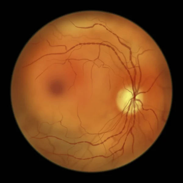 Non Proliferative Diabetic Retinopathy Illustration Showing Venous Beading Ophthalmoscope View — Fotografia de Stock