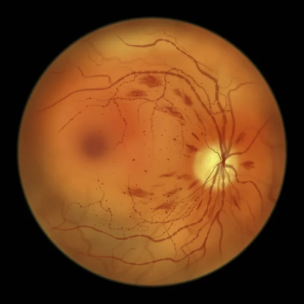 Non Proliferative Diabetic Retinopathy Illustration Showing Irmas Intraretinal Microvascular Abnormalities — Fotografia de Stock