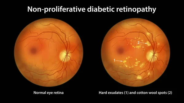 Non Proliferative Diabetic Retinopathy Illustration Showing Normal Eye Retina Retina — Foto de Stock