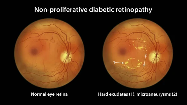 Non Proliferative Diabetic Retinopathy Illustration Showing Normal Eye Retina Retina — 스톡 사진
