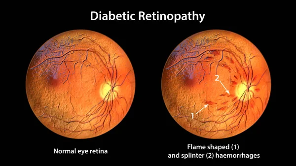 Non Proliferative Diabetic Retinopathy Ophthalmoscope View Illustration Showing Normal Eye — Foto de Stock
