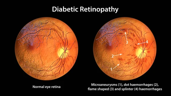 Non Proliferative Diabetic Retinopathy Illustration Showing Normal Eye Retina Retina — Foto de Stock