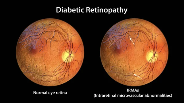 Non Proliferative Diabetic Retinopathy Illustration Showing Normal Eye Retina Retina — Foto de Stock