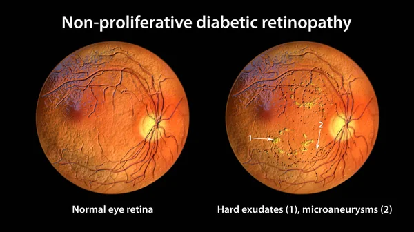 Non Proliferative Diabetic Retinopathy Illustration Showing Normal Eye Retina Retina — Stok fotoğraf