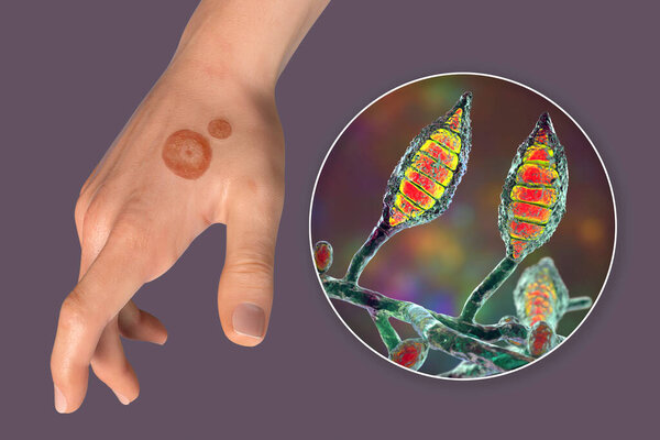 Fungal infection on a man's hand. Tinea manuum and close-up view of dermatophyte fungi Microsporum canis, 3D illustration