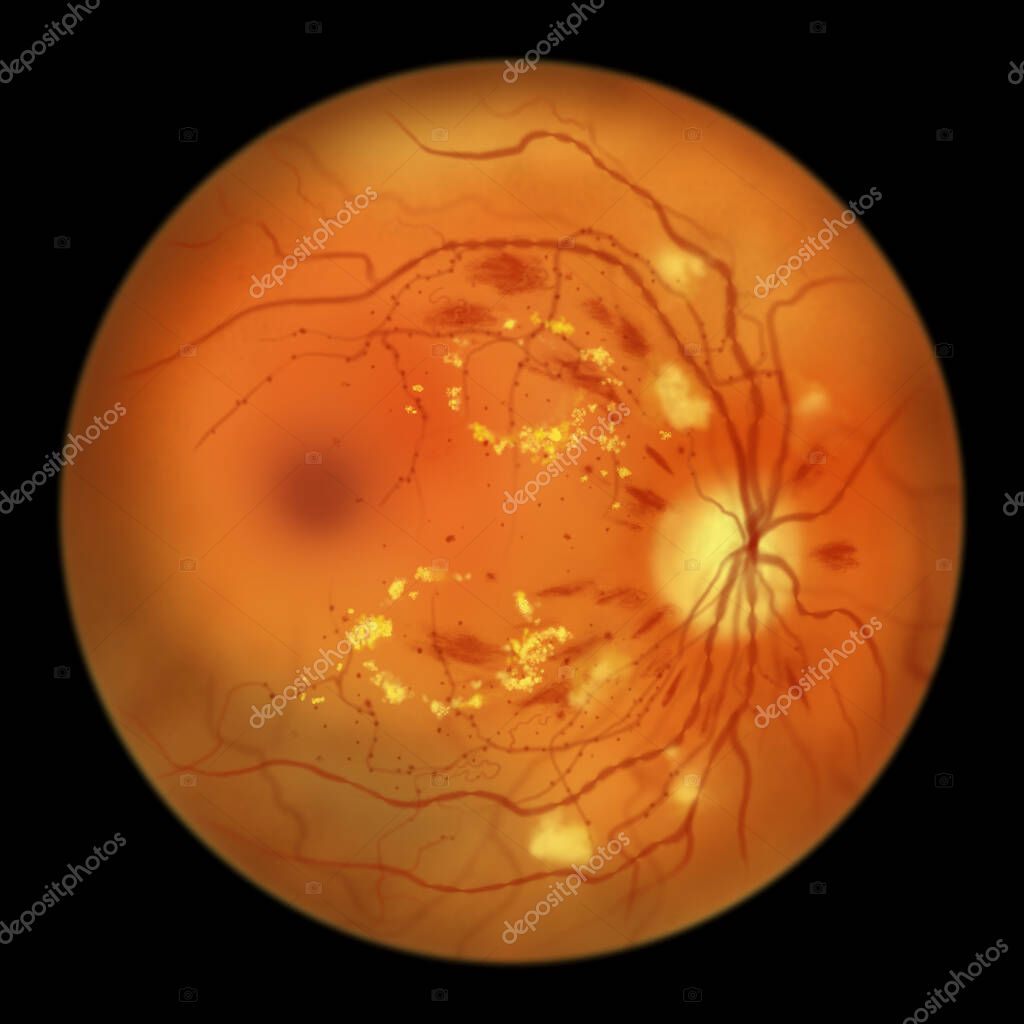 Diabetic retinopathy nonproliferative, illustration showing hard
