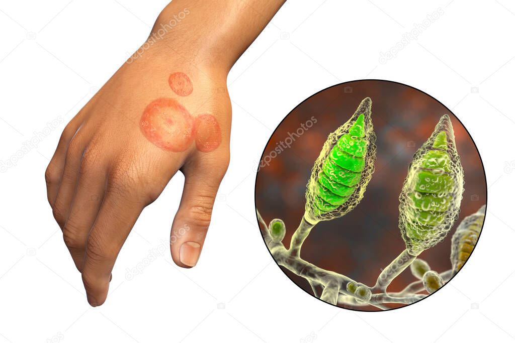 Fungal infection on a man's hand. Tinea manuum and close-up view of dermatophyte fungi Microsporum canis, 3D illustration