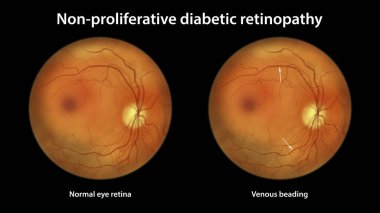 Yaygın olmayan diyabetik retinopati, göz retinasını ve retinasını venöz boncuklu gösteriyor.
