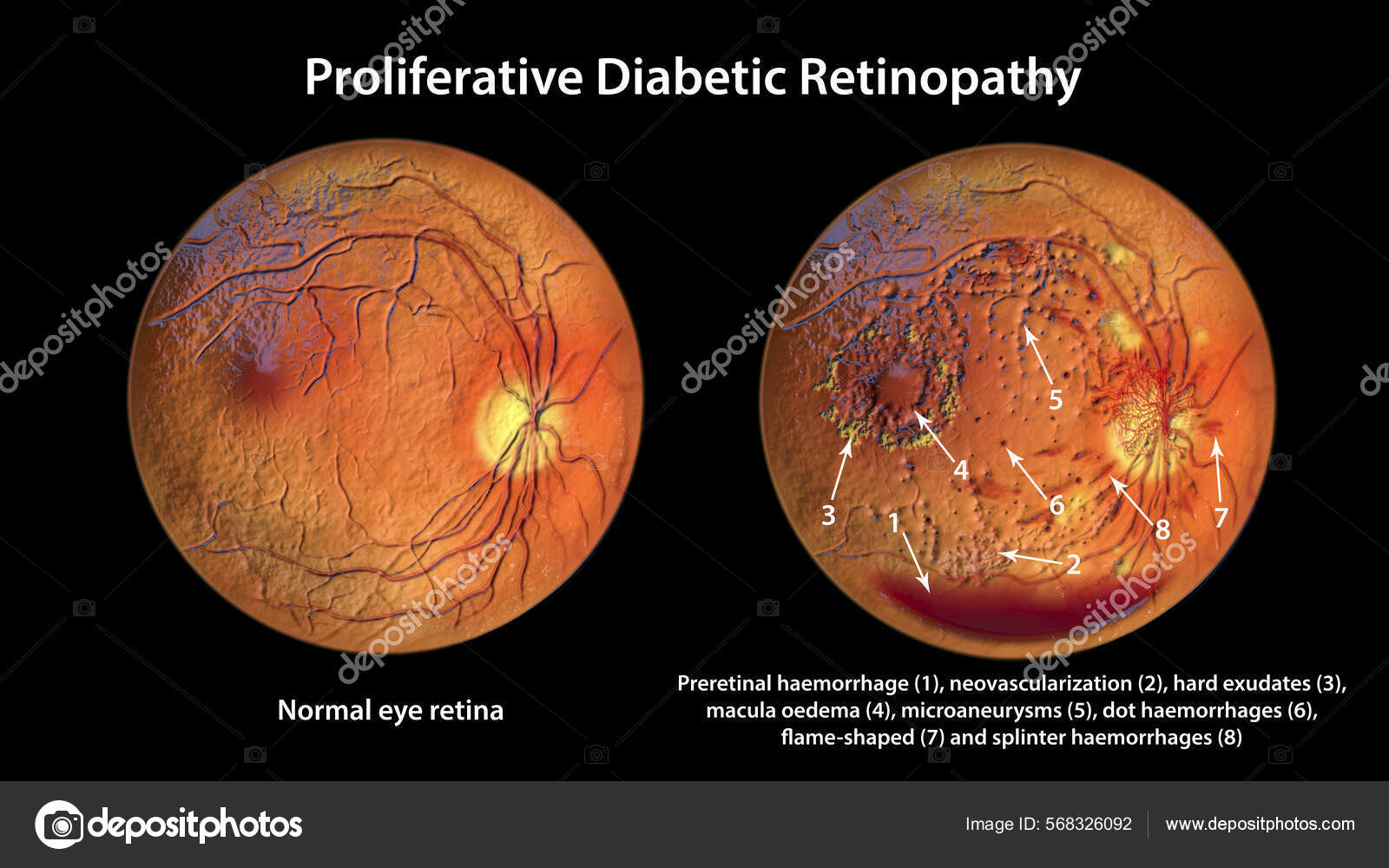 Proliferative Diabetic Retinopathy Illustration Shows Preretinal