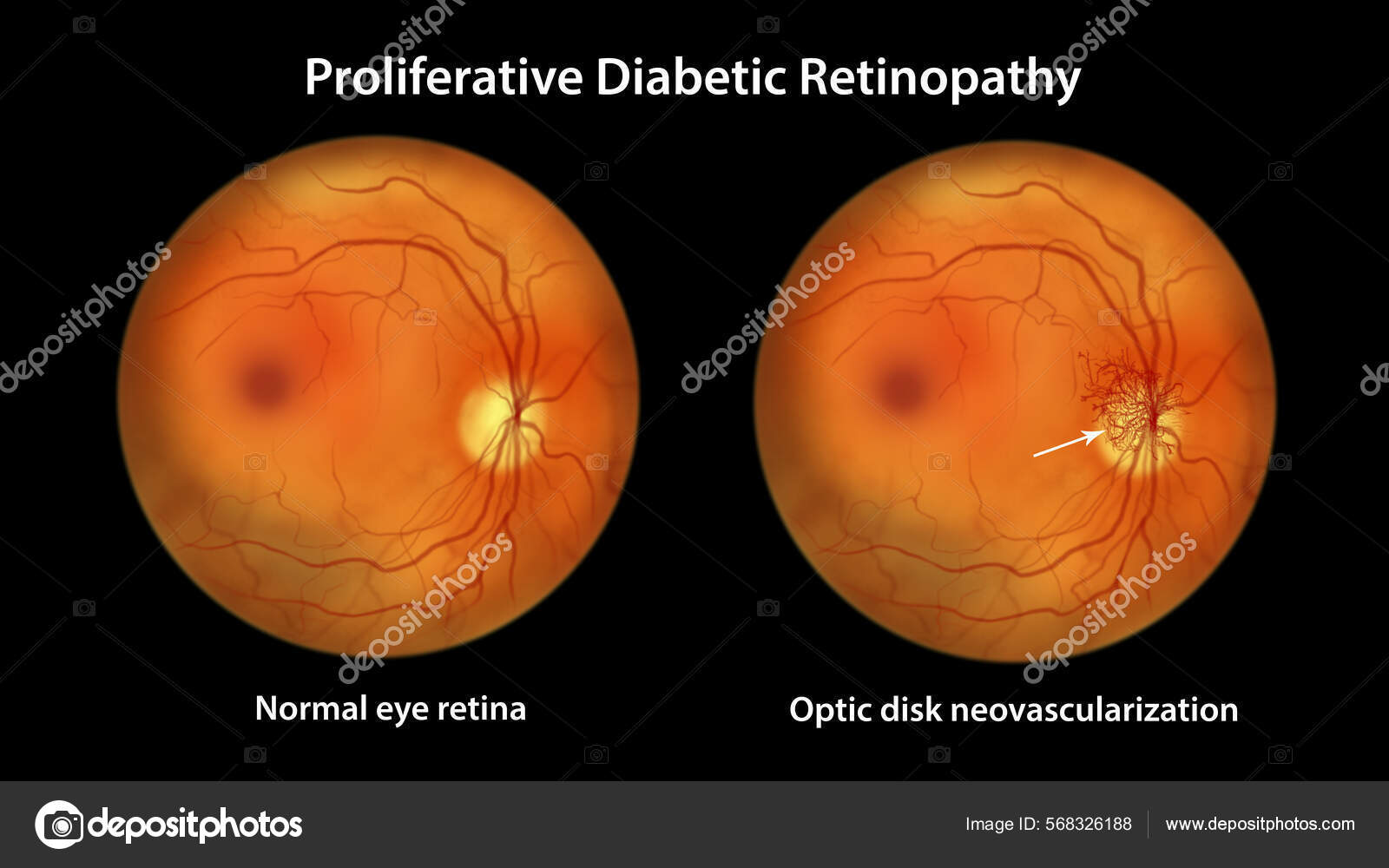 Proliferative Diabetic Retinopathy Illustration Showing