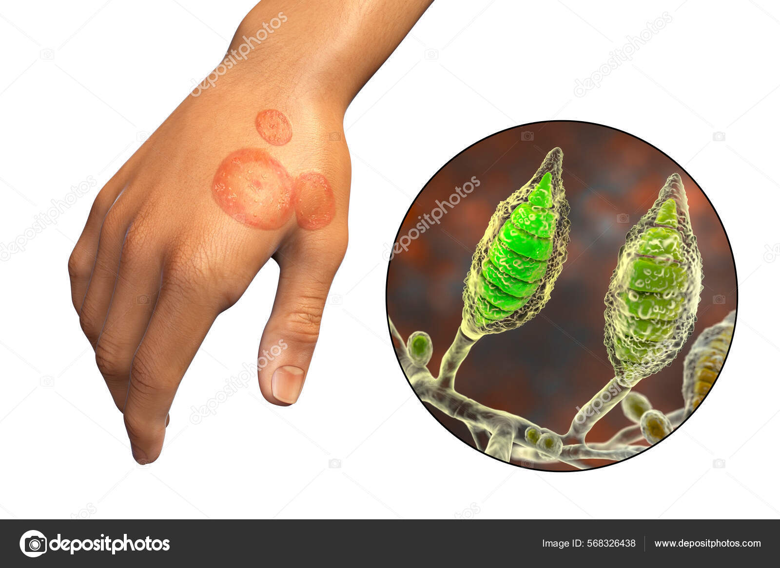 Infecção Fúngica Mão Homem Tinea Manuum Visão Perto Fungos