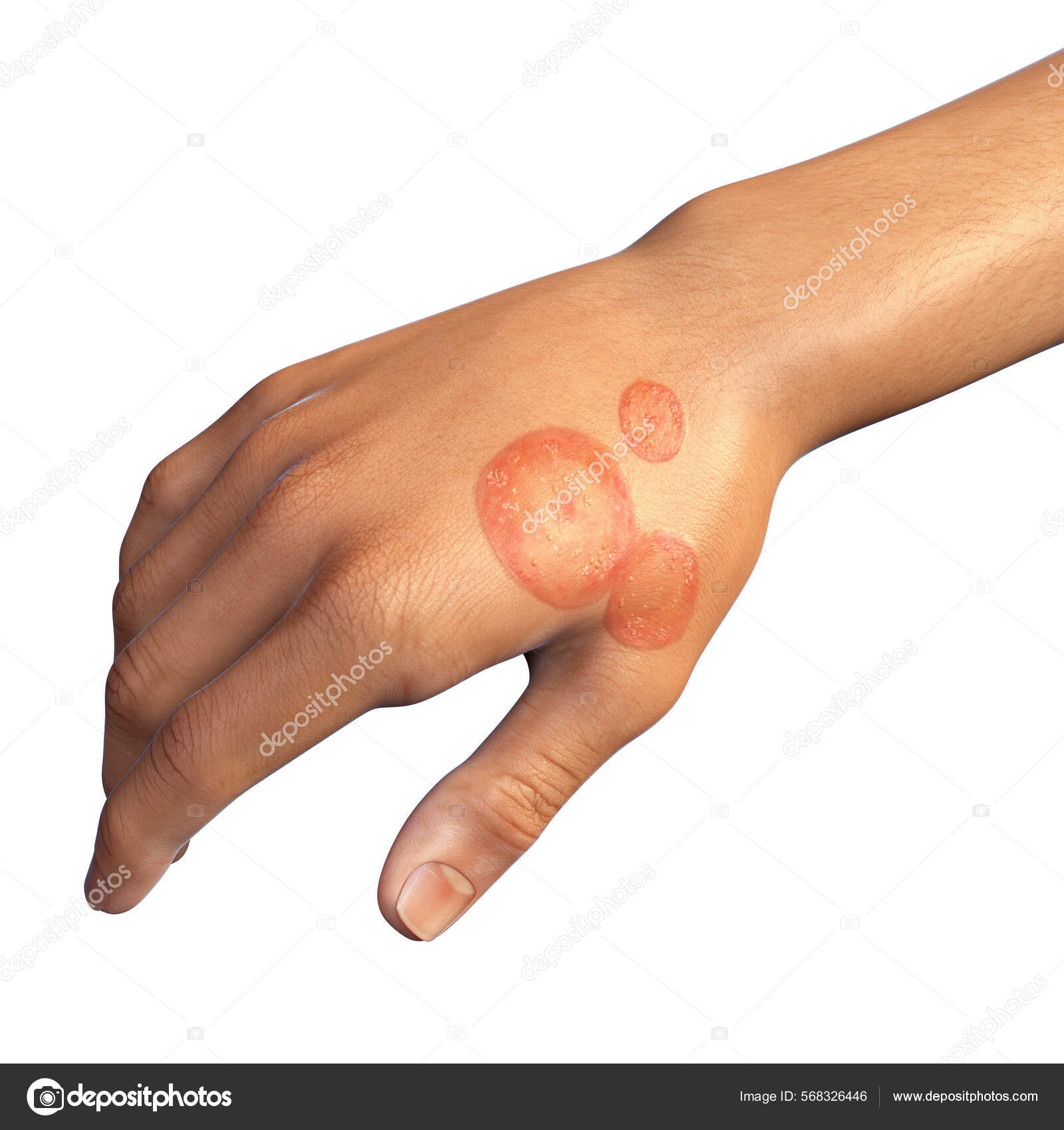 Fungal Infection Man's Hand Tinea Manuum Illustration Stock Photo by  ©katerynakon 568326446