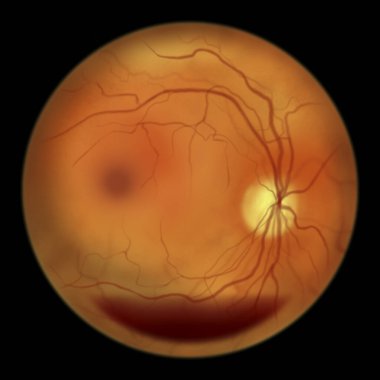 Diyabetik retinopati, illüstrasyon yatay kan seviyesi olarak preretinal kanama (tekne şeklinde kanama), fundoskopik göz retinasının diyabet mellitus muayenesinde anormal bulguları gösterir.