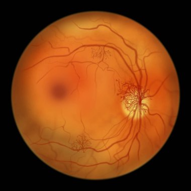 Proliferatif diyabetik retinopati, optik disk ve diğer sitelerde yeni damarların oluşumunu gösteren illüstrasyon. Göz retinasının diyabetteki Fundoskopik muayenesi