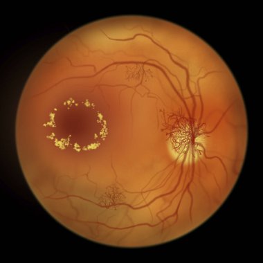 Üreme diyabetik retinopati, diskte ve diğer sitelerde neovaskülarizasyonu gösteren illüstrasyon, macula ödemi ve sert exüdatlar. Göz retinasının diyabetteki Fundoskopik muayenesi