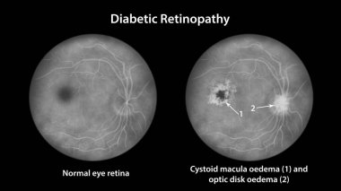 Diyabetik maküler ödem (DME), illüstrasyon sistoid macula ödemi ve optik disk ödemi, fundoskopik göz retinasının diyabet mellitus, floressein anjiyografisi üzerinde anormal bulgular göstermektedir.