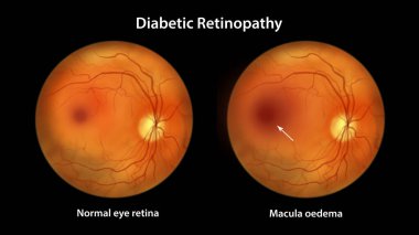 Diabetic macular edema (DME), illustration showing normal eye retina and retina with macula edema. Fundoscopic examination of the eye retina in diabetes mellitus