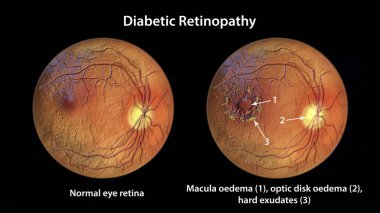 Diabetic retinopathy, 3D illustration showing macula edema, optic disk edema and hard exudates, abnormal finding on fundoscopic examination of the eye retina in diabetes mellitus clipart