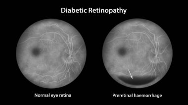 Diyabetik retinopati, illüstrasyon preretinal kanamayı yatay kan seviyesi olarak gösterir (tekne şeklinde kanama), floressein anjiyografisi