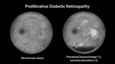 Üretken diyabetik retinopati, yatay kan seviyesi olarak preretinal kanama ve neovaskülarizasyon (yeni damarların oluşumu), floressein anjiyografisi olarak gösterilen illüstrasyon