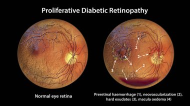 Üreme diyabetik retinopati, yatay kan seviyesi olarak preretinal kanamayı gösteren 3 boyutlu illüstrasyon, disk ve diğer sitelerde neovaskülarizasyon, macula ödemi ve sert çıkışlar.