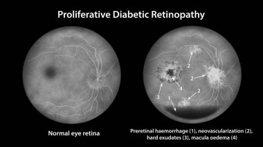 Üreme diyabetik retinopati, preretinal kanamayı gösteren illüstrasyon, diskte ve diğer sitelerde neovaskülarizasyon, sistoid macula ödemi ve sert exüdatlar, floressein anjiyografisi.