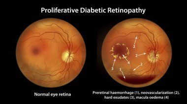 Proliferative diabetic retinopathy, illustration showing preretinal haemorrhage as horizontal blood level, neovascularization in the disk and other sites, macula edema and hard exudates