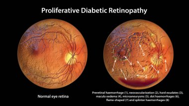 Üreme diyabetik retinopati, 3 boyutlu illüstrasyon preretinal kanama, neovaskülarizasyon, makula ödemi, sert çıkıntılar, pamuk yünü lekeleri, mikro anevrizmalar, küçük kanamalar, venöz boncuklanma gösteriyor.