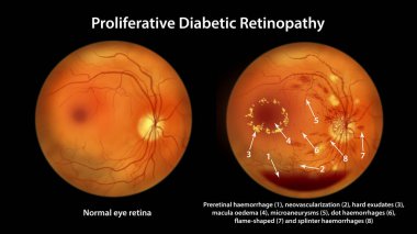 Proliferative diabetic retinopathy, illustration showing preretinal haemorrhage, neovascularization, macula edema, hard exudates, cotton wool spots, microaneurysms, small haemorrhages, venous beading