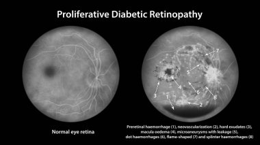 Üreme diyabetik retinopati, preretinal kanama, neovaskülarizasyon, makula ödemi, sert exüdatlar, mikroanevrizmalar, küçük hemoraji, floresein anjiyografisi gösteren illüstrasyon.