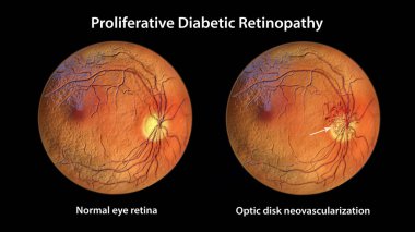 Proliferatif diyabetik retinopati, optik diskte yeni damarların oluşumunu gösteren 3 boyutlu illüstrasyon. Göz retinasının diyabetteki Fundoskopik muayenesi