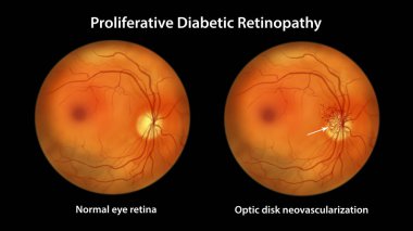 Proliferatif diyabetik retinopati, optik diskte yeni damarların oluşumunu gösteren illüstrasyon. Göz retinasının diyabetteki Fundoskopik muayenesi