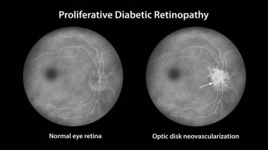 Proliferatif diyabetik retinopati, optik diskte yeni damarların oluşumunu gösteren illüstrasyon. Göz retinası diyabetik mellitus, florasan anjiyografi.