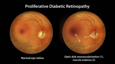 Yaygın diyabetik retinopati, diskte ve macula ödeminde neovascularizasyon gösteren illüstrasyon. Şeker hastalığında göz retinasının fundoskopik muayenesinde anormal bulgular