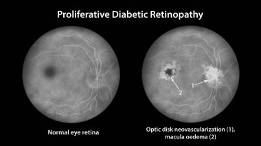 Üretken diyabetik retinopati, diskte neovascularizasyon ve sistoid macula ödemi gösteren illüstrasyon. Şeker hastalığında göz retinasının fundoskopik muayenesinde anormal bulgular