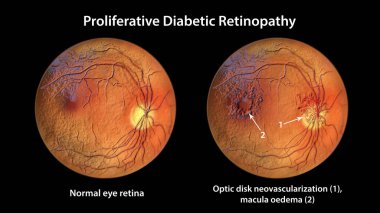 Üretken diyabetik retinopati, diskte ve macula ödeminde neovascularizasyon gösteren üç boyutlu illüstrasyon. Şeker hastalığında göz retinasının fundoskopik muayenesinde anormal bulgular